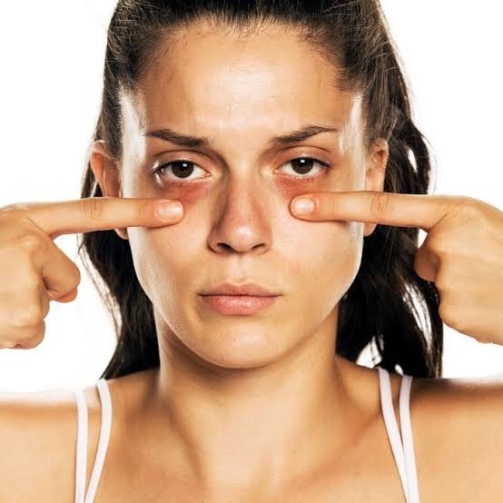 Know the causes of dark circles and how to get RID-OFF?